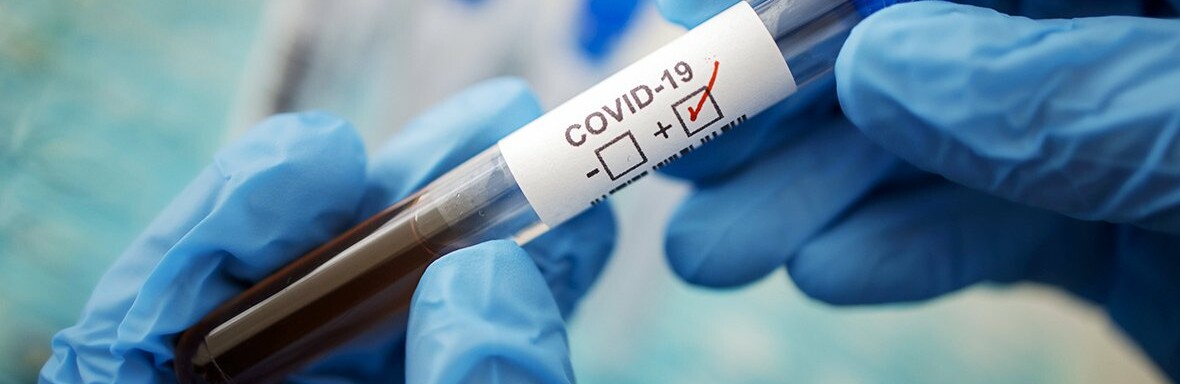 Тест на COVID-19 могут назначить не только при соответствующих симптомах